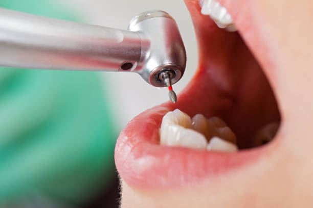 Best Emergency Treatment for Dental Infections or Abscesses in Thiells, NY